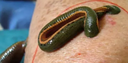 Leech Therapy (Jalaukavacharana)